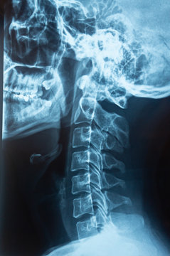Cervical spine skeleton x-ray film of a patient with military neck or straight neck, medical concept photo