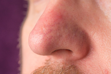 the surface of the skin with rosacea and eczema