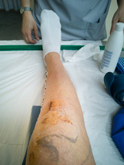 Knee Injury after Stitches have been removed  After Knee Surgery