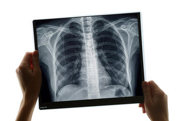 Examination of a chest x-ray - obrazy, fototapety, plakaty