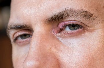 Fototapeta premium Eye infection. Eye disease. Swollen men's eye. Closeup