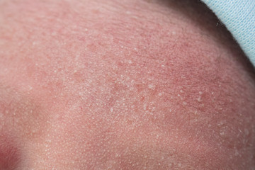 Fototapeta premium Macro, close-up shot of the milia on a two day old baby cheek, nose and forehead.