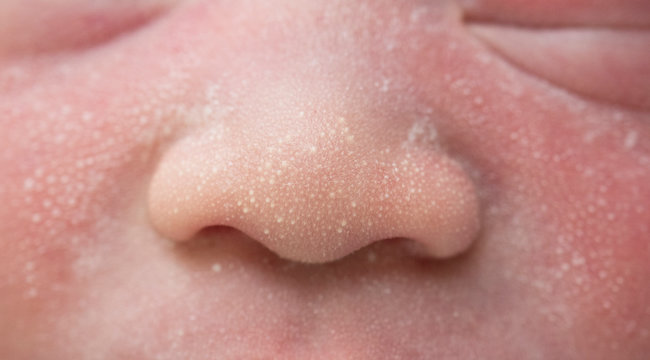 Macro, close-up shot of the milia on a two day old baby cheek, nose and forehead.