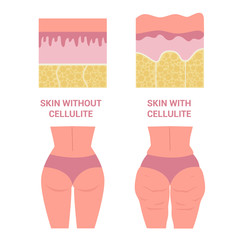 Young woman thighs with and without cellulite. Girl in underwear