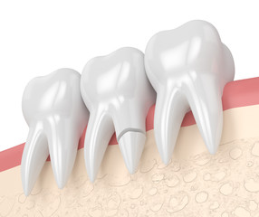 3d render of gums with cracked tooth root