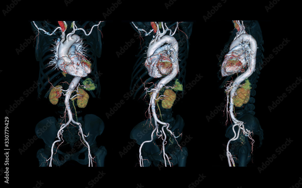 Poster cta whole aorta 3d rendering image on black background for detect aortic aneurysm.
