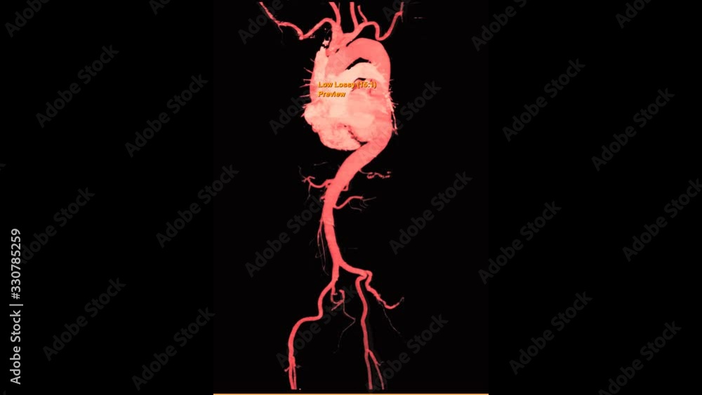 Poster cta whole aorta 3d mip image turn around on the screen for detect aortic aneurysm.