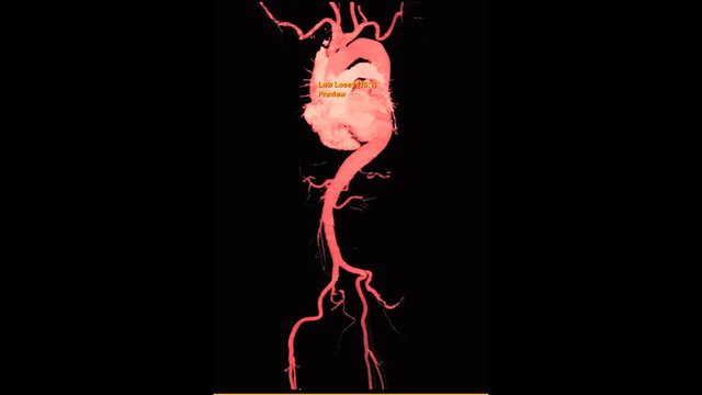 CTA Whole aorta 3D MIP image turn around on the screen for detect aortic aneurysm.