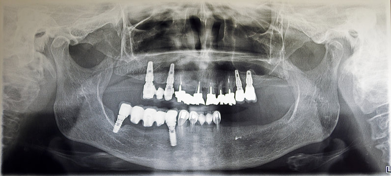 Orthopantomography of an adult patient,digital radiographic acquisition
