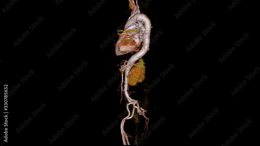 Poster cta whole aorta 3d rendering image turn around on the screen for detect aortic aneurysm.