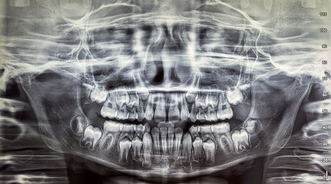 Orthopantomography of an adult patient,digital radiographic acquisition