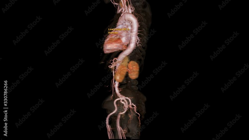 Poster cta whole aorta 3d rendering image with transparent bone turn around on the screen for detect aortic