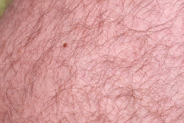 Mole on the male hairy leg.