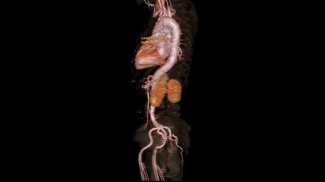 CTA Whole aorta 3D rendering image with transparent bone turn around on the screen for detect aortic aneurysm.