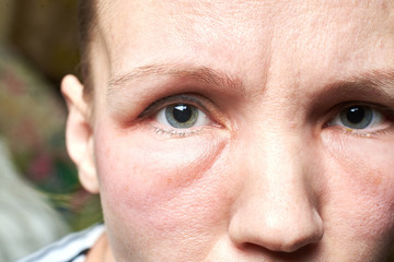 Swollen face of a woman under the eyes, swelling. An allergic reaction to drugs, cosmetics.