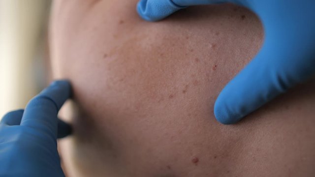Physician dermatologist examining huge birthmark in woman's back with hands in blue gloves, diagnosis of skin cancer or melanoma close up.