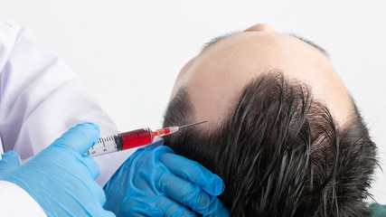 Close up of a bald man receiving injection in scalp from doctor. Man's head with gloves holding...