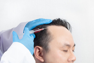 Close up of a bald man receiving injection in scalp from doctor. Man's head with gloves holding syringe on white background. Hair loss problem, alopecia treatment and hair growth concept.