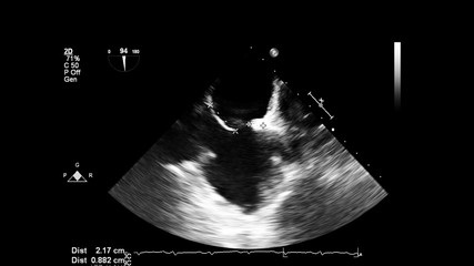 Image of the heart in gray-scale mode during transesophageal ultrasound.