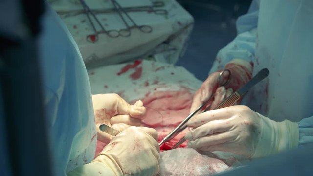 Patient's wound is being stitched during surgery