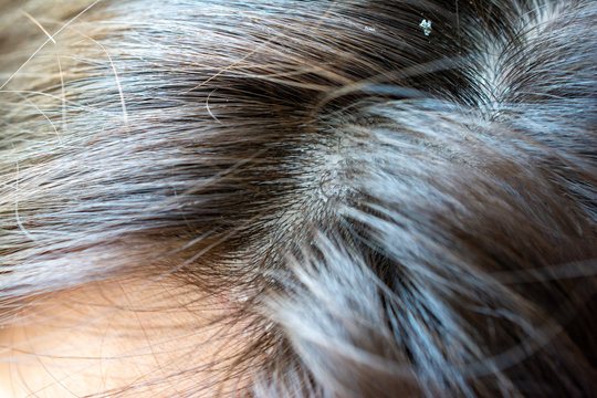 Dandruff seborrhea problem of scalp and hair treatment of peeling from allergies. Scalp dermatoses. Fatty Dandruff.