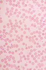 Essential thrombocytosis blood smear, present abnormal high platelet and neutrophil cell, analyze...
