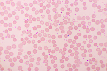 Essential thrombocytosis blood smear, present abnormal high platelet and neutrophil cell, analyze by microscope