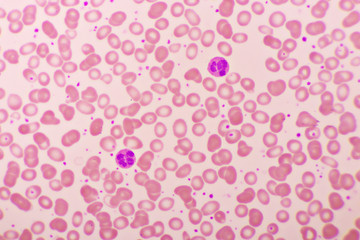 Essential thrombocytosis blood smear, present abnormal high platelet and neutrophil cell, analyze by microscope