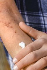 a wounds atepic dermatitis in the hands of a child