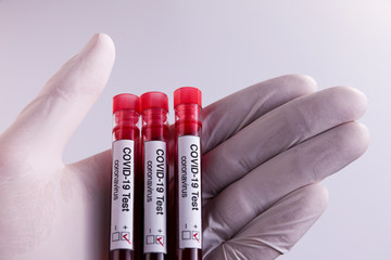Doctor holds three COVID-19 coronavirus blood samples in his hand. All patients were tested positive for the virus. Health Concept.