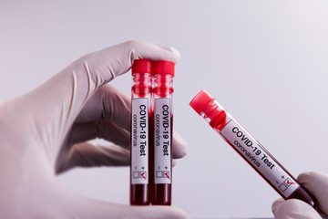 Doctor holds COVID-19 coronavirus blood samples in his hands. The patients were tested positive for the virus. Health Concept.