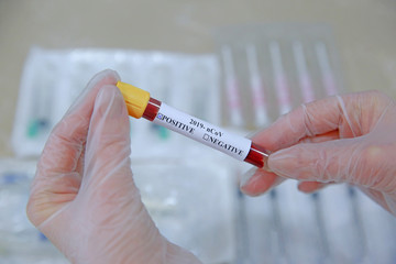 Positive COVID-19 test and laboratory sample of blood testing for diagnosis new Corona virus...