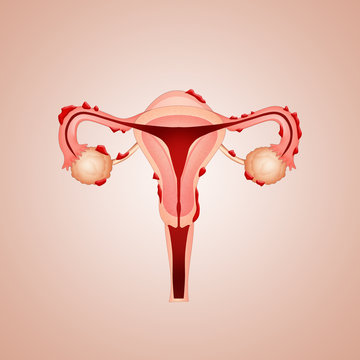 uterus with endometriosis