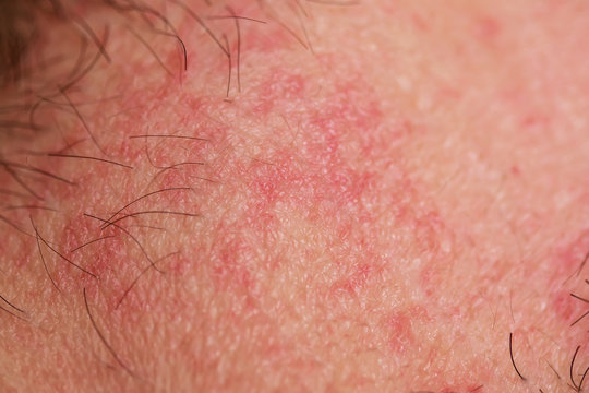 background with the texture of irritated reddened skin of a man's neck covered with hair and bristles