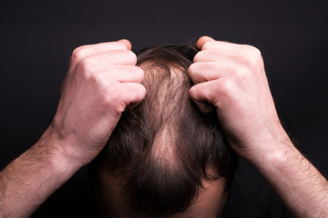 A man grabs his hair. Head with baldness. The problem of hair growth on the head.