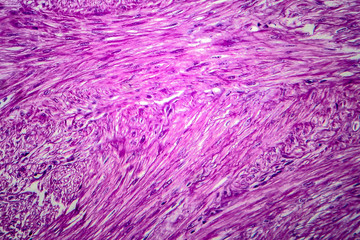 Uterine leiomyoma, light micrograph