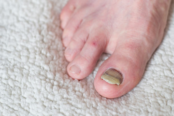 Nail injury Treatment of bruises and fractures. Damage to the nail phalanx. The effect of wearing...