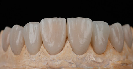 Dental Laminate veneers, smile design.