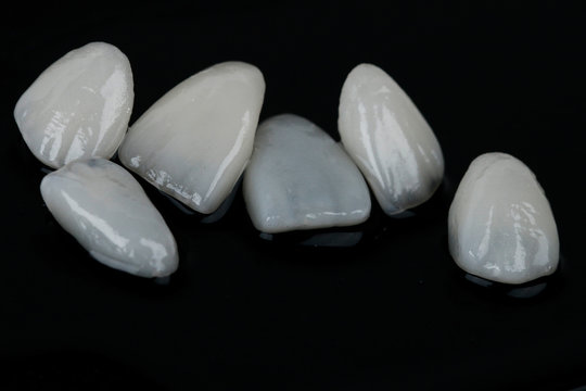 Dental Laminate veneers, smile design.