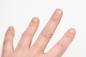 Close-up of brittle nails. A broken nail on your finger.