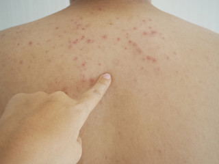 man pointing finger at the back and heat rash,prickly heat on skin cause by outdoor work in the...