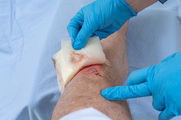 Nurse caring fresh blooded injury wound on the tibial bone of the leg. Sticking stitches to hold the cut. - obrazy, fototapety, plakaty