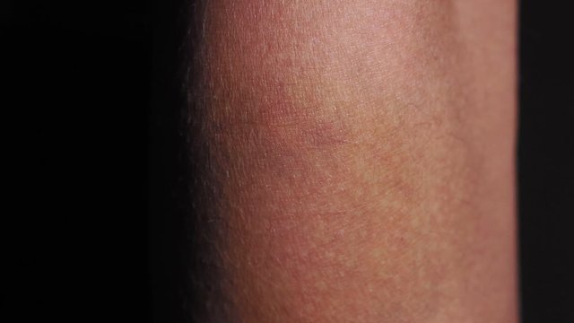 Bright bruise of human injury. Close-up pain concept. hematomas on the hand