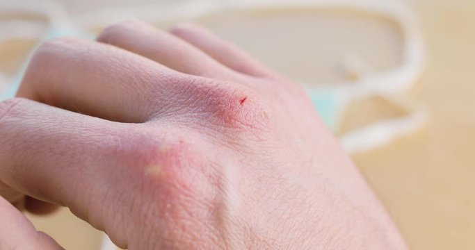 Coronavirus covid-19, mano arrossata e con ferite di medico e infermiere in ospedale dopo turni massacranti. Cura pazienti in terapia intensiva e rianimazione in Italia.