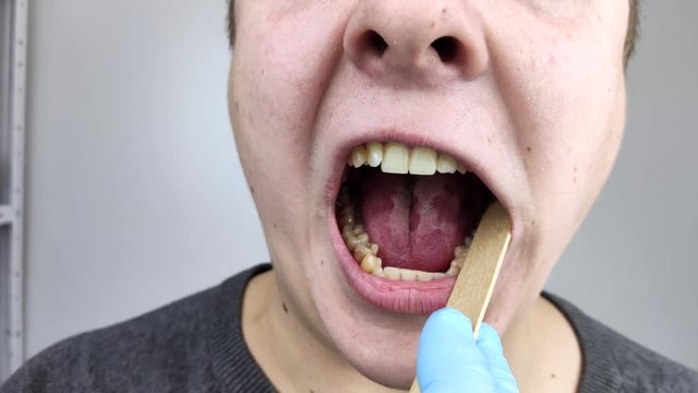 An otolaryngologist examines a man throat with a wooden spatula. A possible diagnosis is inflammation of the pharynx, tonsils or pharyngitis. The concept of treatment and prevention of throat disease