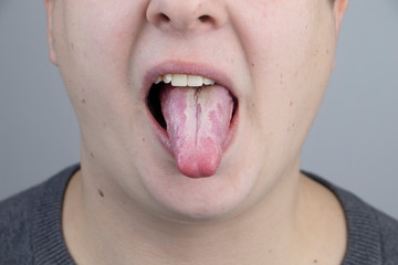 White curd on the tongue. A physician or gastroenterologist examines a man’s tongue. Patient has...