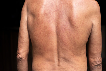 Fototapeta na wymiar Problem skin rash from allergy symptoms.