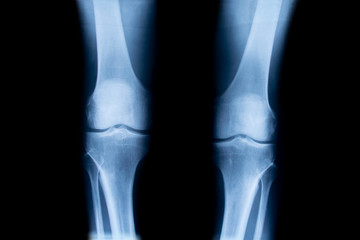 X-ray of human knees, closeup