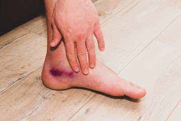 Sprained ligaments on the man's leg. Bruise. The swelling of the foot. Apply ointment to the leg.