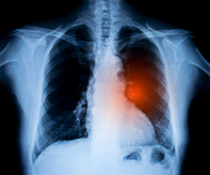 X-ray image of chest. Lung cancer concept